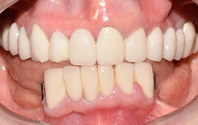 Отсутствие жевательных зубов на нижней челюсти