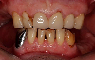 Фото состояния зубов пациента до проведенного лечения