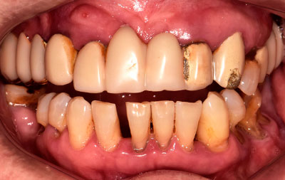 Фото зубов с пародонтитом