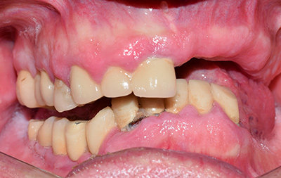 Частичное отсутствие зубов и атрофия кости