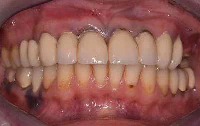 Фото до восстановления всех зубов на обеих челюстях