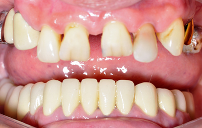 подвижность и выпадение зубов на верхней челюсти
