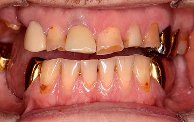 Фото: проблема с зубами до начала лечения