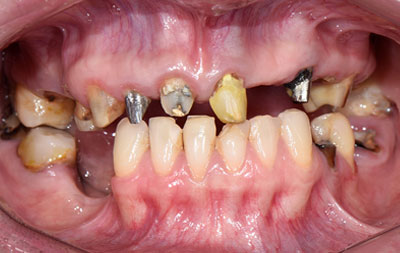 Фото до комплексной имплантации зубов All on 4 Nobel Biocare