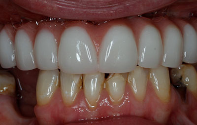 Фото после комплексной имплантации зубов All on 4 Nobel Biocare