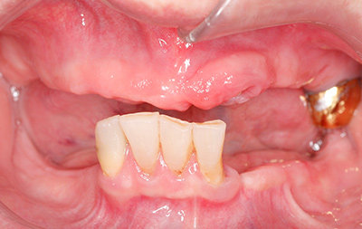 Почти полное отсутствие зубов и атрофия костной ткани