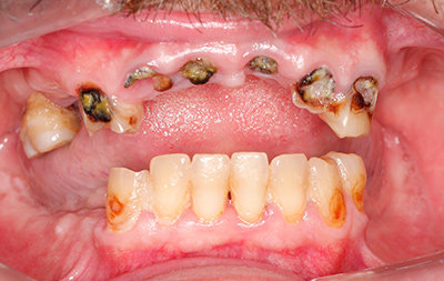 Множественное разрушение зубов на верхней челюсти