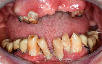 Фото зубов пациента до имплантации