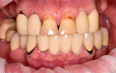 Фото проблемы с зубами до имплантации