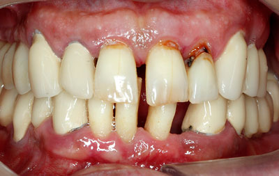 Фото зубов с пародонтитом у пациента