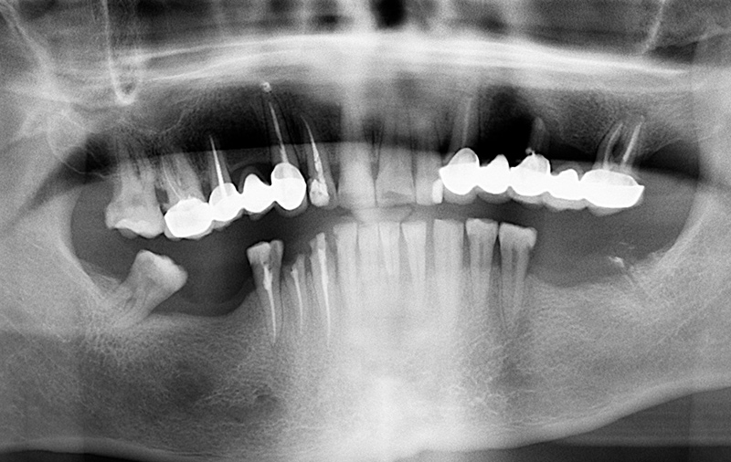Снимок Патологическая стираемость зубов, хронический пародонтит, разрушение зубов до корней