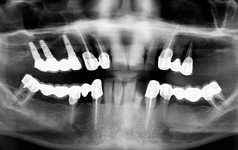 Снимок Фото зубов с пародонтитом у пациента