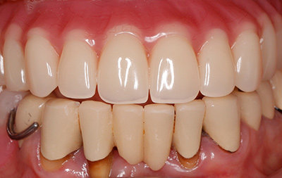 Восстановление зубов при помощи протокола All-on-4 