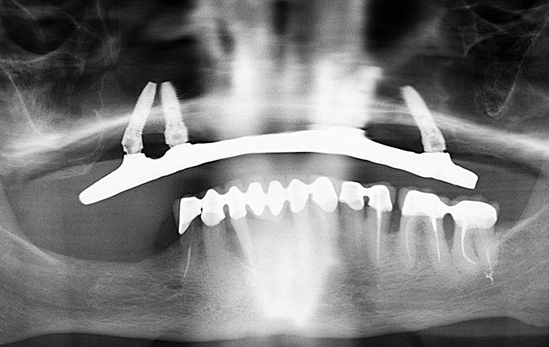 Снимок Восстановление зубов при помощи протокола All-on-4 