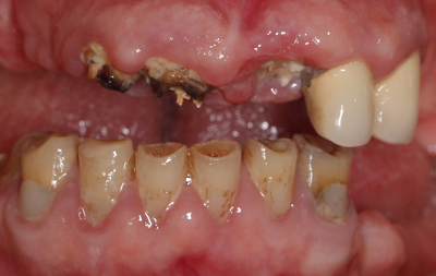 Запущенный пародонтит и гниение оставшихся зубов