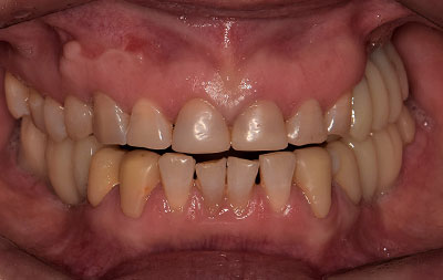 Фото после установки зубных имплантов Straumann