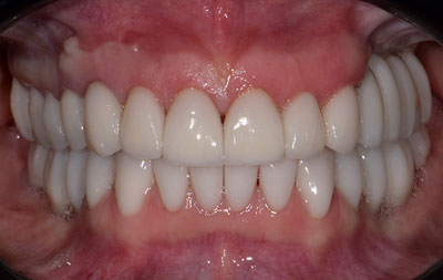 Фото после установки виниров на зубы