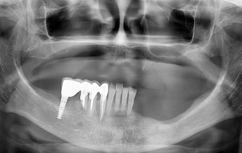 Снимок Отсутствие зубов и атрофия костной ткани