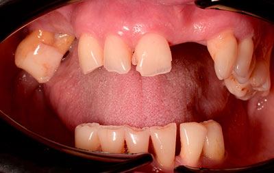 Фото зубов пациентки до имплантации зубов