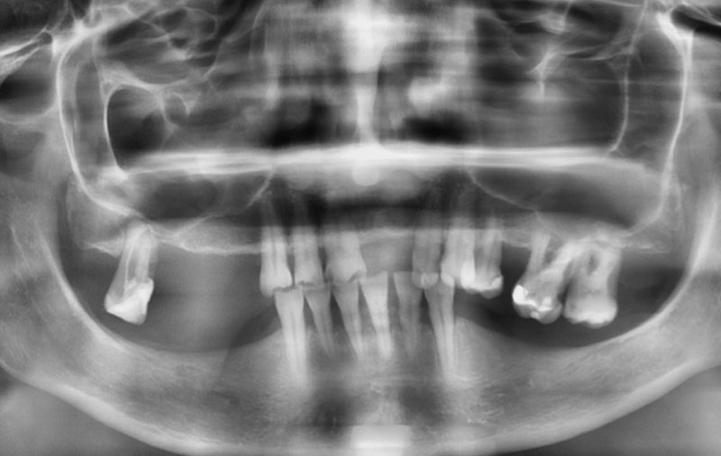 Снимок Фото зубов пациентки до имплантации зубов