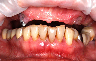 Почти полное отсутствие зубов на верхней челюсти 