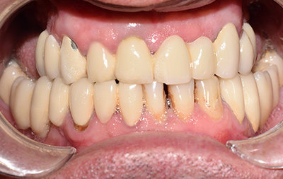 разрушение опорных зубов под мостовидными протезами