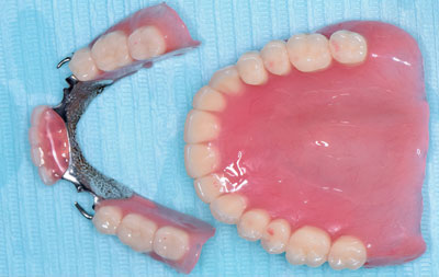 протезы на зубы
