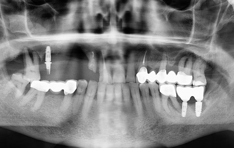 Снимок Множественное отсутствие зубов до имплантации
