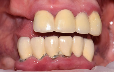 Фото до проведения имплантации зубов All-on-6