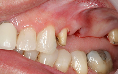 Отсутствие жевательных зубов на верхней челюсти