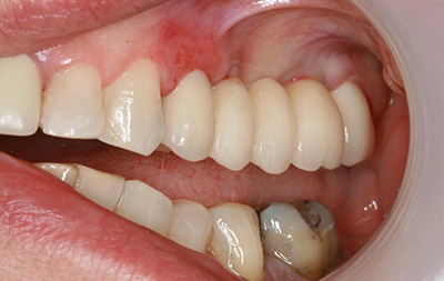 Восстановление отсутствующих зубов с помощью имплантации 