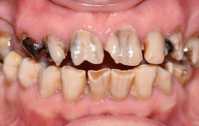 Разрушение зубов в результате множественного кариеса