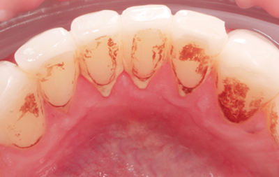 Наличие пигментированного зубного налета и камня на зубах