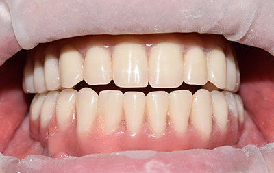 Восстановление зубов с помощью имплантации All-on-4
