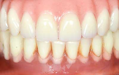 Фото после установки зубных протезов на импланты