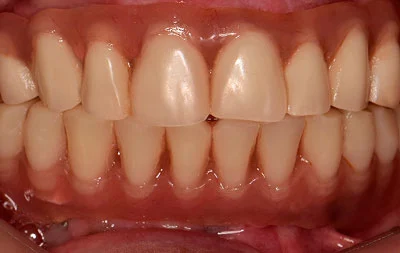 Фото зубов после установки адаптационных протезов