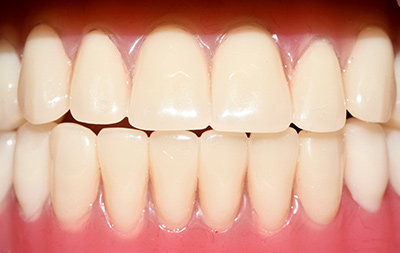 Восстановление всех зубов с немедленной установкой несъемных зубных протезов