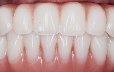 Имплантация зубов all-on-4