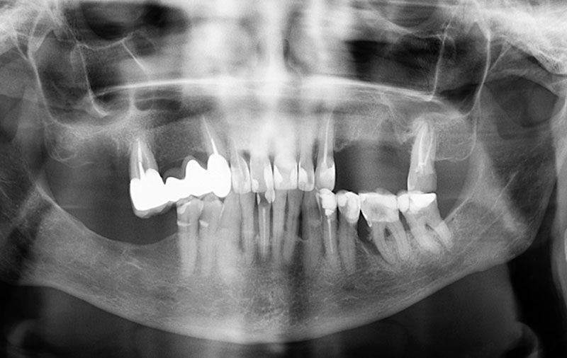 Снимок Зубы до имплантации