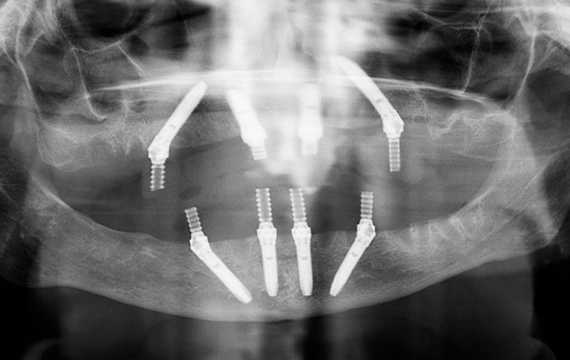 Снимок Имплантация зубов all-on-4