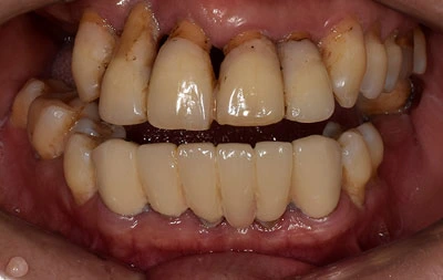 Фото состояния зубов до комплексной имплантации за 1 день