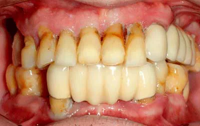 Фото зубов до операции по комплексной имплантации зубов