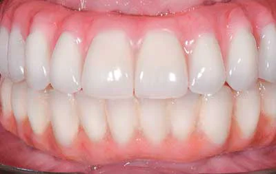 Фото зубов после операции по комплексной имплантации верхней челюсти