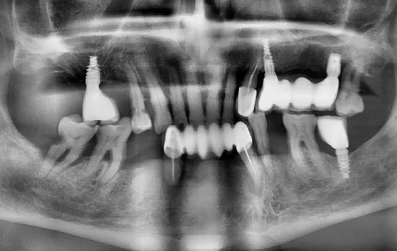 Снимок Фото зубов до операции по комплексной имплантации зубов