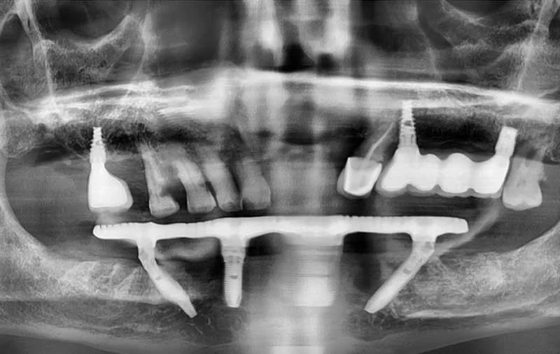 Снимок Фото зубов после операции по комплексной имплантации нижней челюсти
