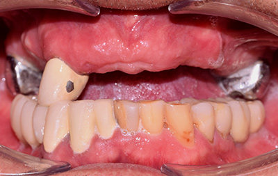 Практически полное отсутствие зубов на верхней челюсти