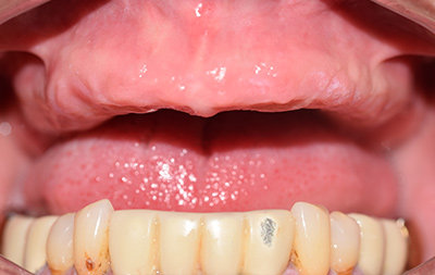 Отсутствие зубов на верхней челюсти 