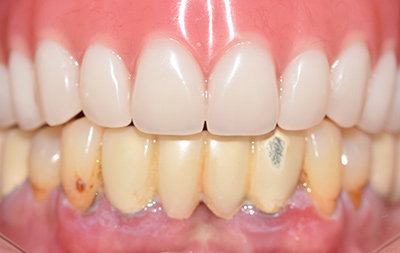 Зубы верхней челюсти восстановлены с помощью съемных протезов