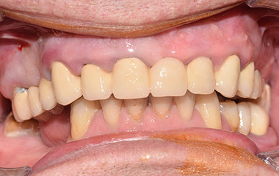 фото зубов до установки протезов