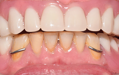 Зубы верхней челюсти восстановлены 
